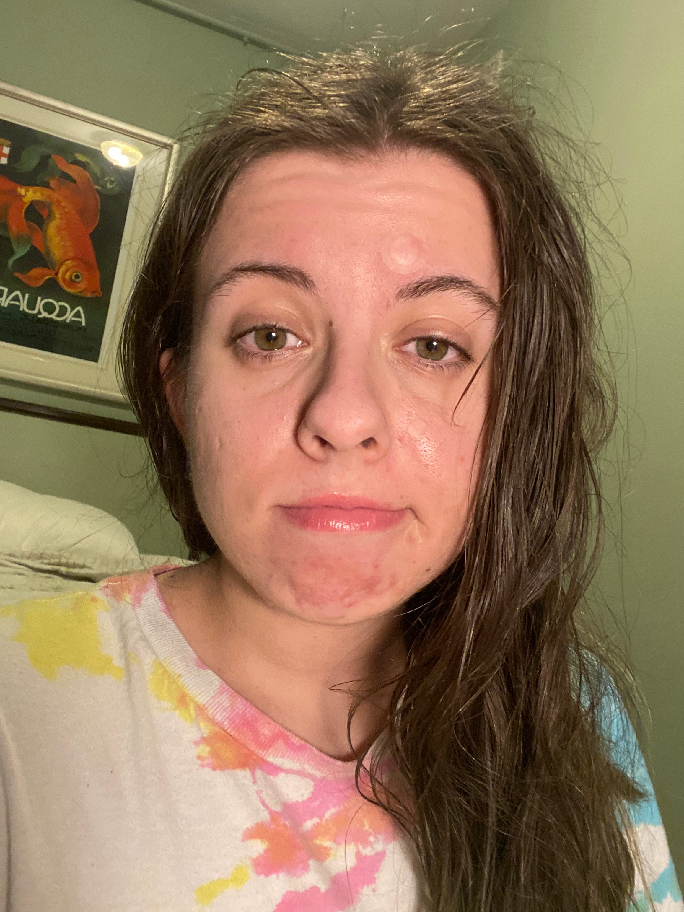 A photo of a white woman in a hotel room staring at the camera as she has frizzy hair, giant eye bags, and a ton of pimple patches on her face.